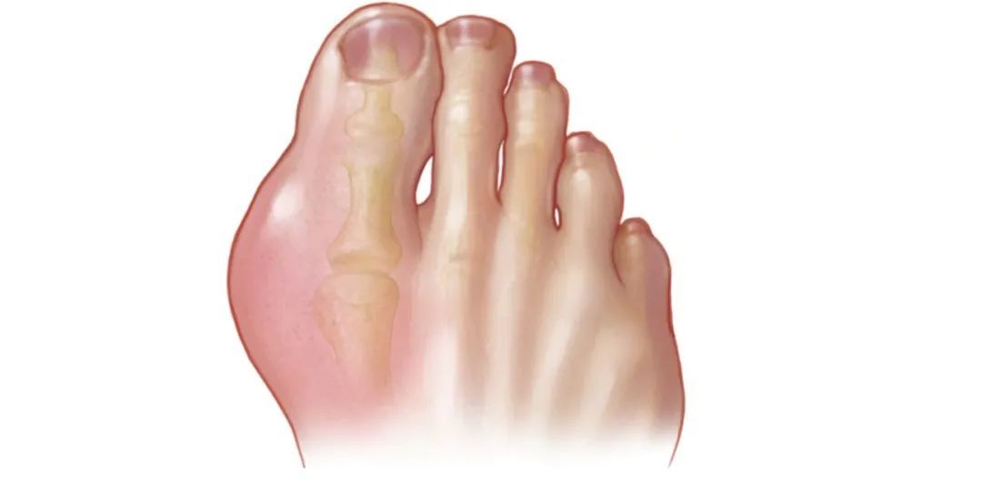 误把痛风当成关节炎,我以为自己要瘸掉